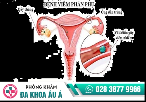 Viêm phần phụ